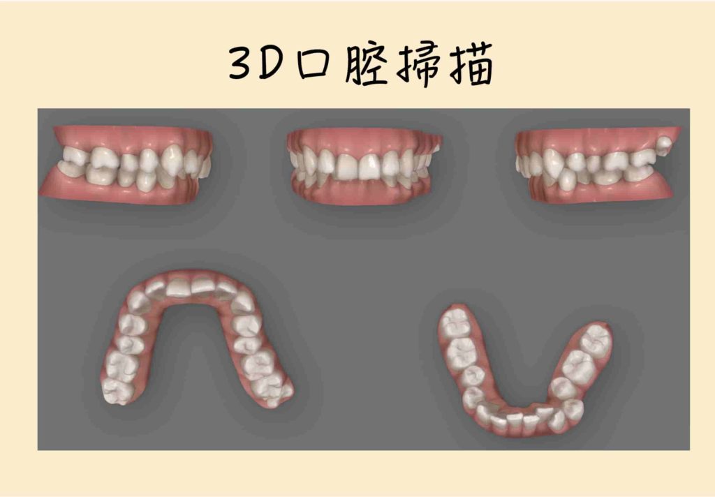 3D口腔掃描像是幫牙齒做3D打印，更清楚地排列情況。