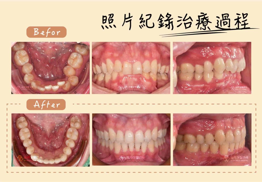 照片紀錄像是幫你和牙齒們拍美美的紀念照，這樣我們就可以更好地規劃出適合你的矯正計畫囉！