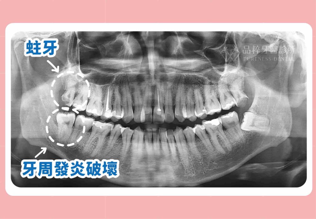 智齒長正的,但有部分牙齒被牙肉蓋住,無法清潔導致牙齦發炎,會建議要拔除。
