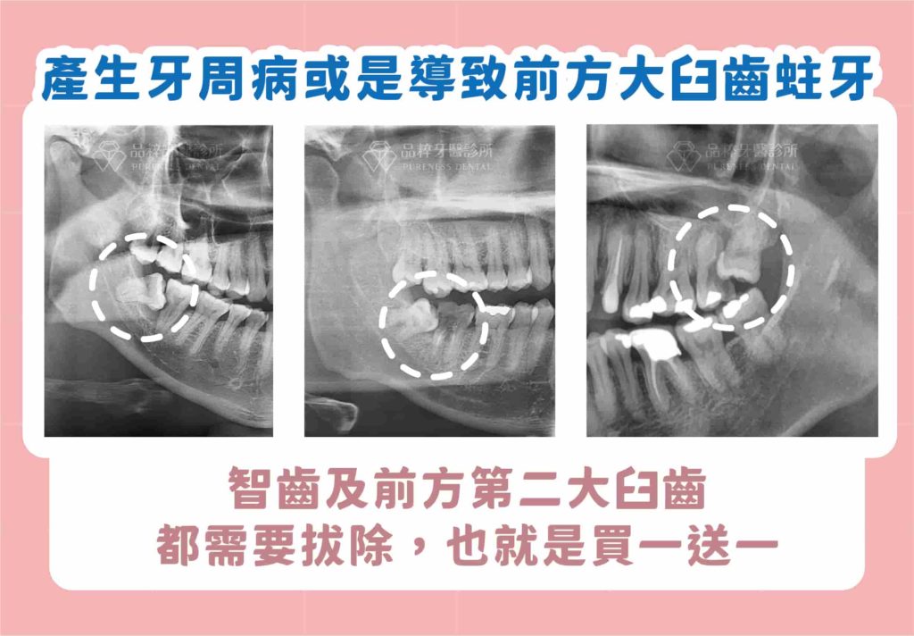 智齒產生牙周病或是導致前方大臼齒蛀牙,智齒及前方第二大臼齒都需拔除