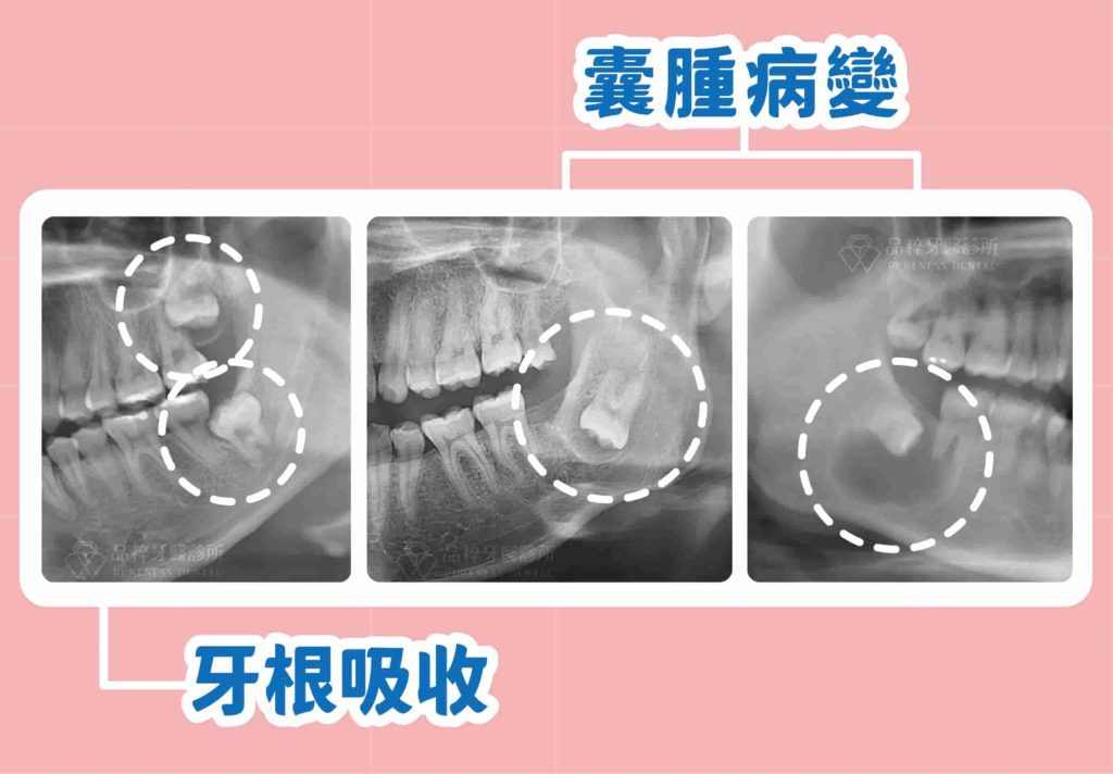 智齒埋在骨頭內,但是有病變出現,如:造成前牙牙根被吸收、囊腫產生,都會建議要處理。