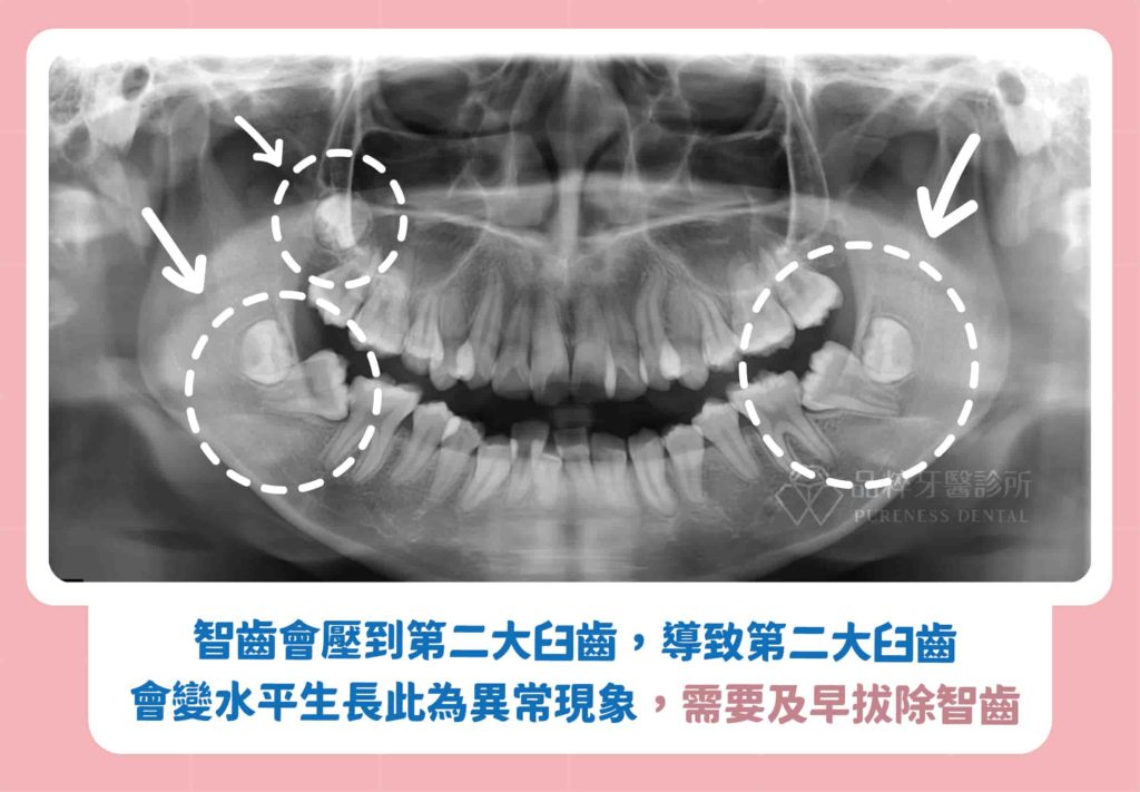 智齒會壓到第二大臼齒,導致第二大臼齒會變水平生長此為異常現象,需要及早拔除智齒。
