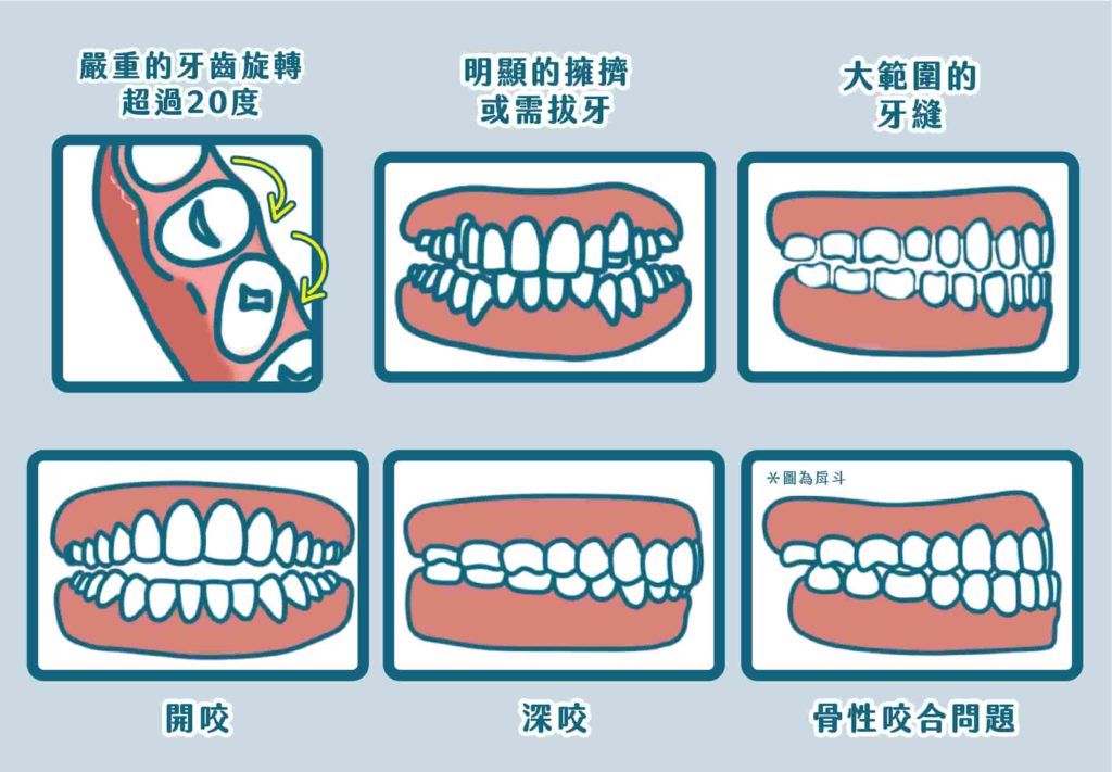 如果有嚴重牙齒旋轉；明顯的擁擠或需拔牙的情況；深咬、開咬與骨性咬合問題；大範圍的牙縫等問題，屬於比較困難的矯正狀況，就需要經過醫師評估適合哪一種矯正方式！