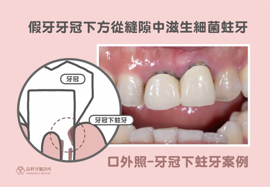假牙牙冠下方從縫隙中滋生細菌蛀牙案例。
假牙跟牙齒的接縫太大，細菌有機會從邊緣滲入。也可能因為牙套材料可能磨損、變形，密合度下降，增加蛀牙風險。