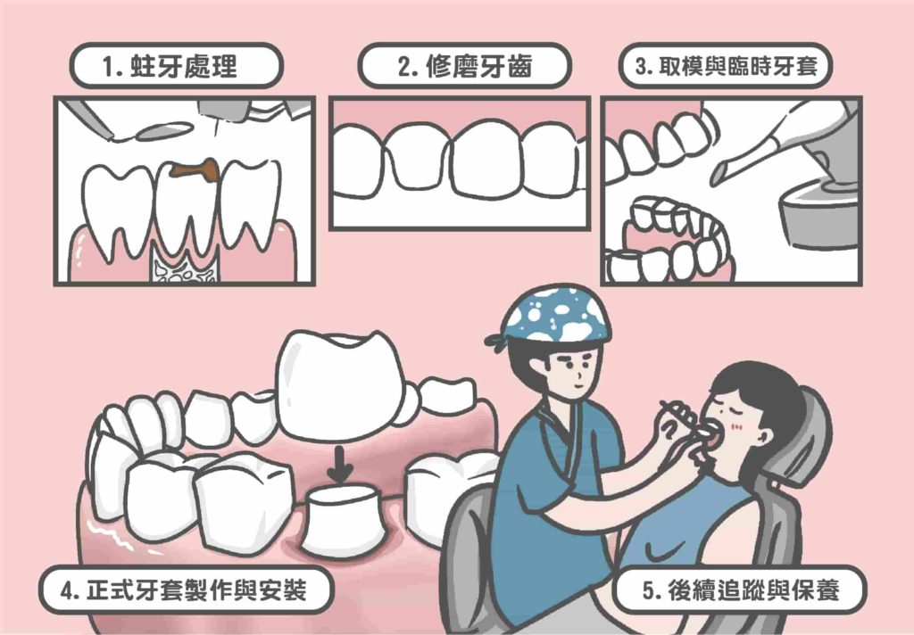 製作牙套的治療順序：蛀牙處理／修磨牙齒／取模與臨時牙套／正式牙套製作與安裝／後續追蹤與保養
