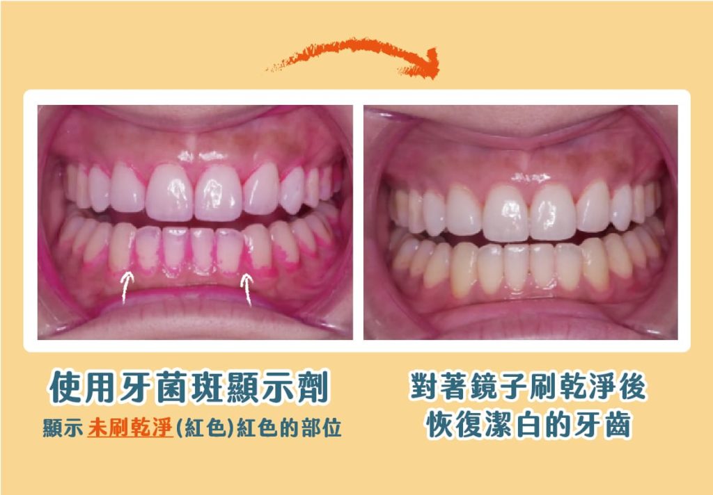 在刷完牙後，使用市售的牙菌斑顯示劑，牙面上殘留紅色的部分，就是牙垢殘留、沒刷乾淨的地方，需要加強清潔。