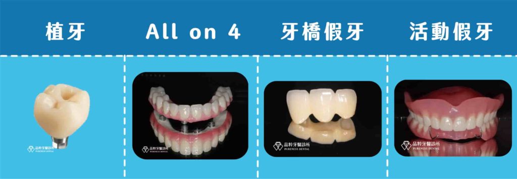常見的假牙種類
植牙、all-on-4、牙橋假牙、活動假牙