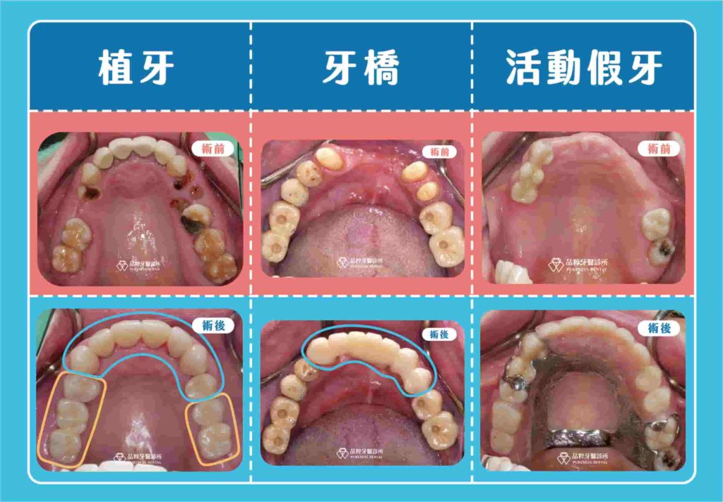 4~9顆缺牙方式案例
