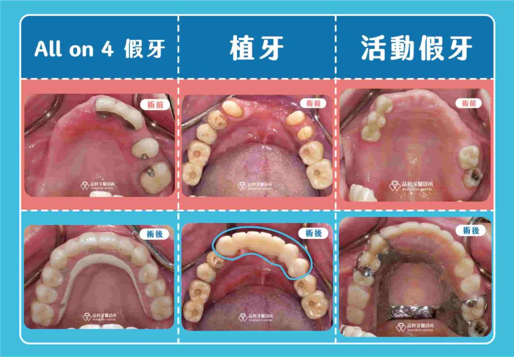 9~14顆缺牙治療方式